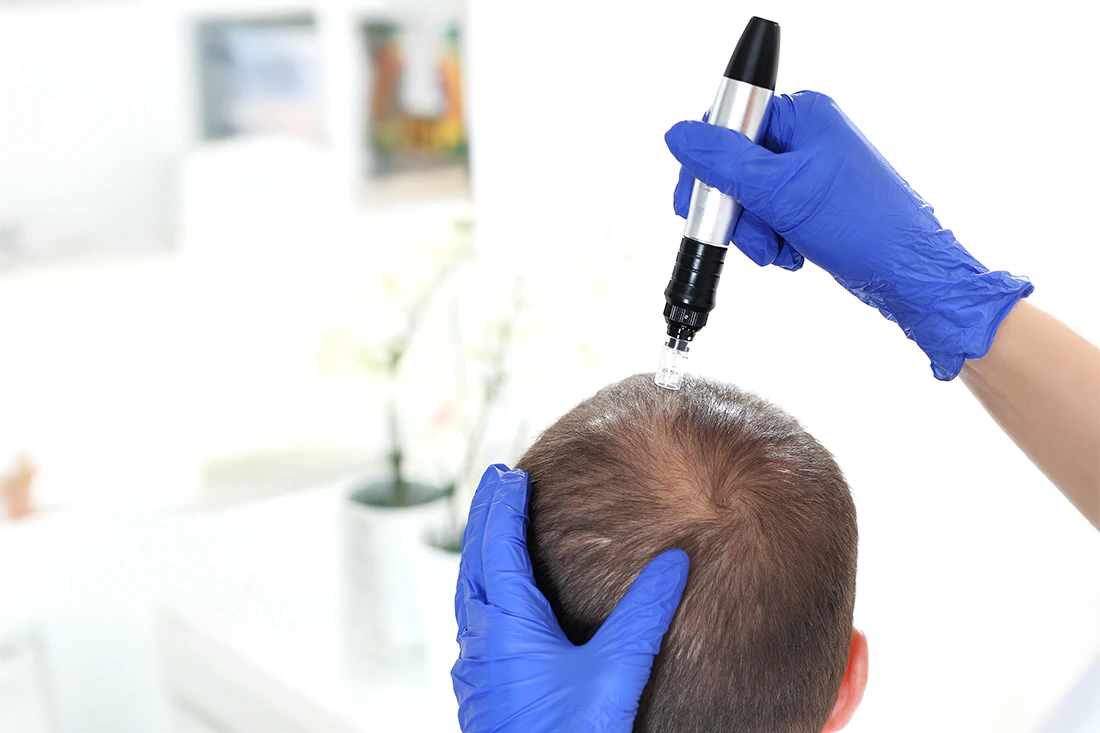 Medizinische-Kosmetik-Haarwachstums-Bremen